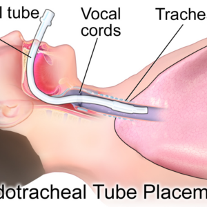 Endotracheal Tube Set